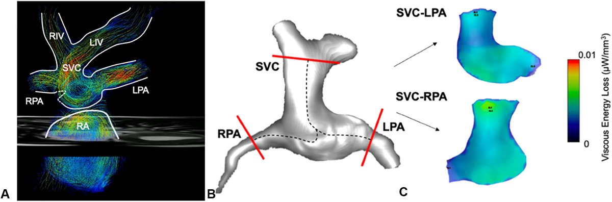 AATS (@aatshq) on Twitter photo New #congenital reserach in #JTCVS Open: Hemi-Fontan and bidirectional Glenn operations result in flow-mediated viscous energy loss at the time of stage II palliation. Read more from researchers at <a href="/CUSystem/">University of Colorado</a> Anschutz Medical Campus: doi.org/10.1016/j.xjon… New #congenital reserach in #JTCVS Open: Hemi-Fontan and bidirectional Glenn operations result in flow-mediated viscous energy loss at the time of stage II palliation. Read more from researchers at <a href="/CUSystem/">University of Colorado</a> Anschutz Medical Campus: doi.org/10.1016/j.xjon…