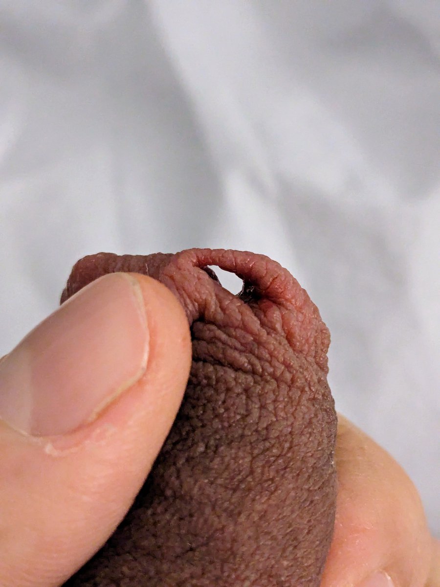 meatoflow's tweet photo. I can see through my 10 mm #foreskin piercing hole. Not sure it will last long as some previous other genital piercings!!
#foreskinpiercing #stretchedpiercing #uncut #bodymods https://t.co/ehIv3aGUsr