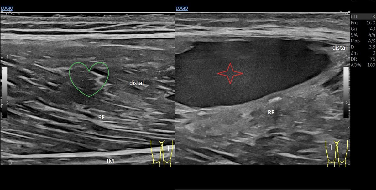 SportklinikBern's tweet photo. #hematoma after #muscleinjury of the #rectusfemoris myofascial, tendon is intact—> #ultrasoundguidedpuncture - #mskus #pocus #pocushub #GElogiqE10r3 https://t.co/CYMAPFuMRf