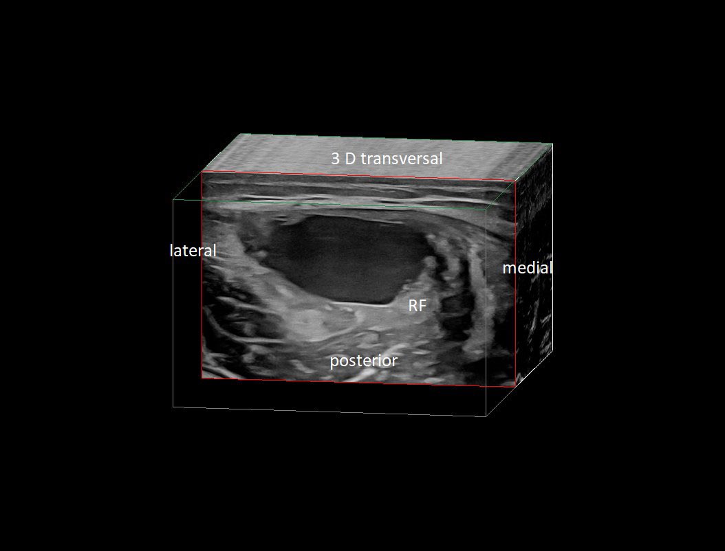 SportklinikBern's tweet photo. #hematoma after #muscleinjury of the #rectusfemoris myofascial, tendon is intact—> #ultrasoundguidedpuncture - #mskus #pocus #pocushub #GElogiqE10r3 https://t.co/CYMAPFuMRf