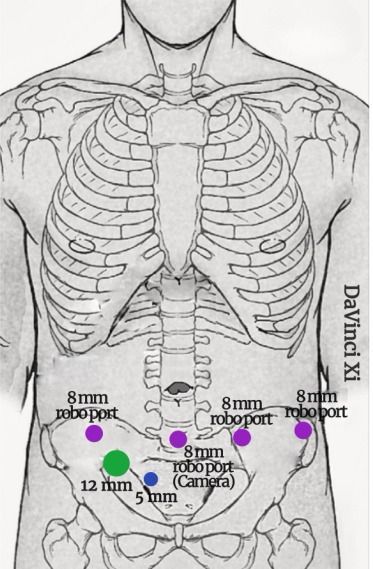 Articles in Press: Propensity-matched Analysis of Open Versus Robotic Primary Retroperitoneal Lymph Node Dissection for Clinical Stage II Testicular Cancer buff.ly/3HTc15y @MichaelASJewett #UroSoMe #Medtwitter #TesticularCancer