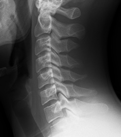 When you design XR/spatial computing systems - the loading on the cervical spine is key (5% female to 95% male is the usual design spectrum, sometimes 1% female to the 99% male). A 600+gram device that is front weight loaded can not be good for anyone with even light spinal