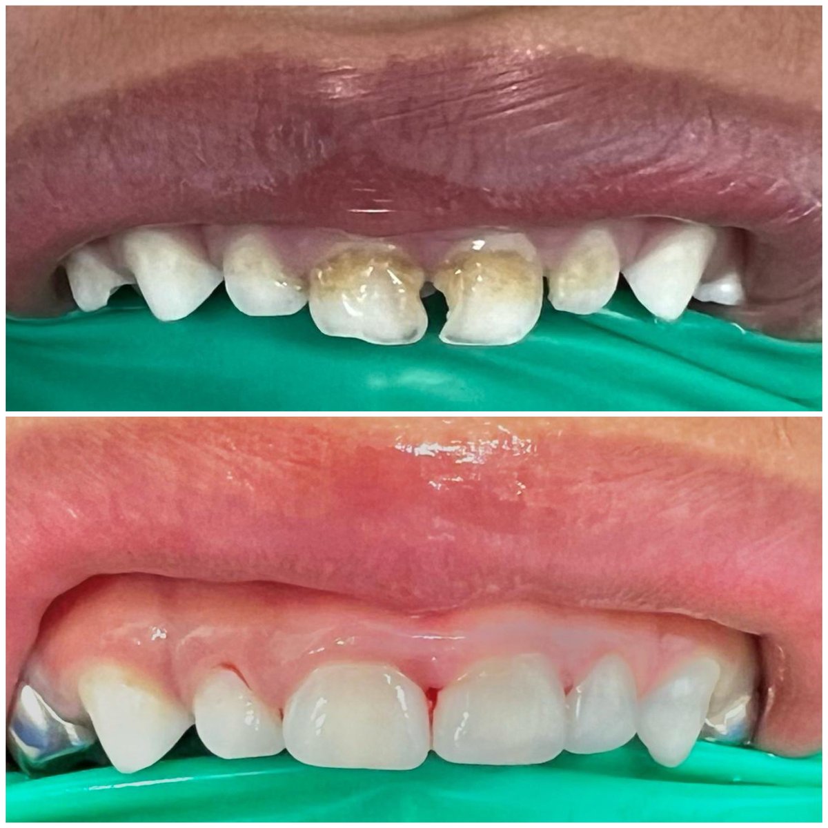 sn_clinic's tweet photo. تم رسم الإبتسامة الجميلة للطفل خلال ساعه واحده بدون الم او خوف تحت التخدير الشامل

لحجز مواعيد التركيبات الاتصال على 1808111
.
#اسنان #الاسنان #سن #الابتسامة #ابتسم #ابتسامة https://t.co/b9jbD9O1sx