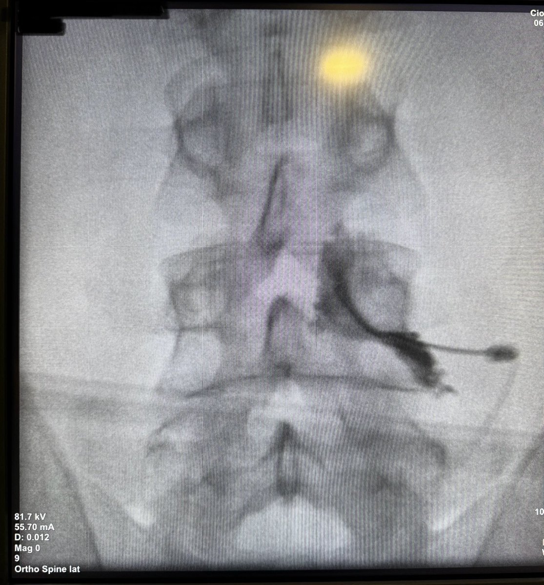 L4 right nerve - Dorsal root ganglion (DRG) pulsed radiofrequency.
