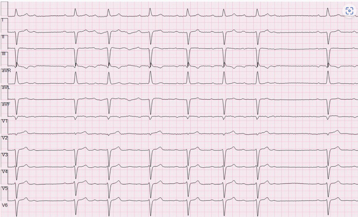 Less Obvious Than One Might Think: Why Is There Grouped Beating? | Circulation ahajournals.org/doi/10.1161/CI…