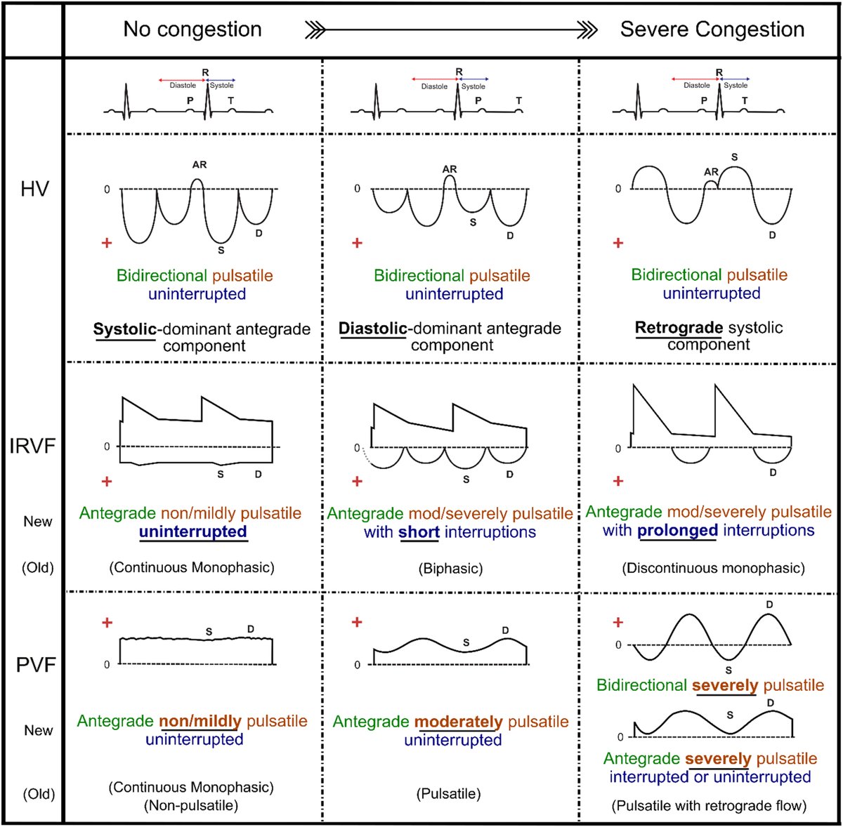 NephroP's tweet image. Transitioning to standardized #VExUS terminology - nice paper reviewing the evidence by our VExUS friends.
#POCUS #MedEd #Nephrology 
🔗clinicalkey.com/#!/content/pla…