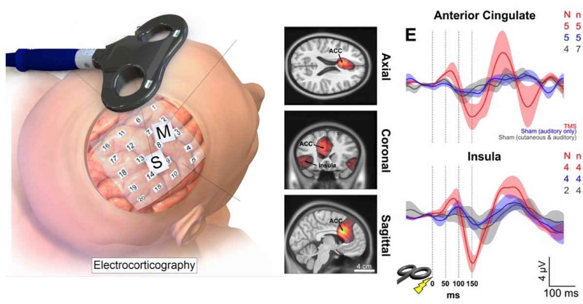 What downstream targets does DLPFC TMS reach?  

We set out to ask this question using intracranial EEG.   6.5 years later and I'm happy to *finally* share our first article using this approach in Molecular Psychiatry.     

trebuchet.public.springernature.app/get_content/52…
