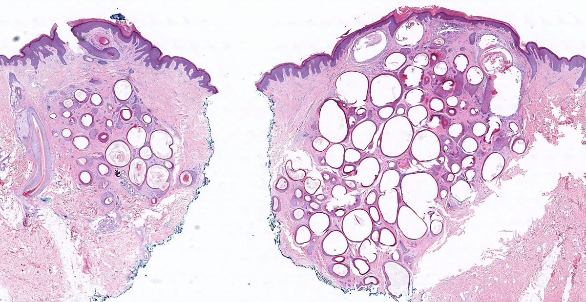 JMGardnerMD's tweet photo. Skin nodule. A rare &amp; beautiful dermpath zebra! Diagnosis?
Answer: https://t.co/E5Fp1lPEdz 
Video: https://t.co/mn8aPJYpih 
#pathology #pathologists #pathTwitter #dermpath #dermatology #dermatologia #dermtwitter https://t.co/BFt5CTkPas
