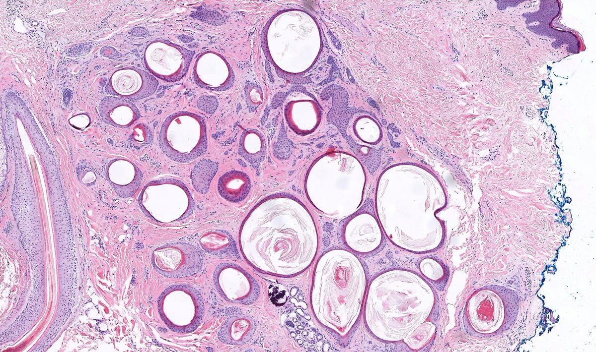 JMGardnerMD's tweet photo. Skin nodule. A rare &amp; beautiful dermpath zebra! Diagnosis?
Answer: https://t.co/E5Fp1lPEdz 
Video: https://t.co/mn8aPJYpih 
#pathology #pathologists #pathTwitter #dermpath #dermatology #dermatologia #dermtwitter https://t.co/BFt5CTkPas