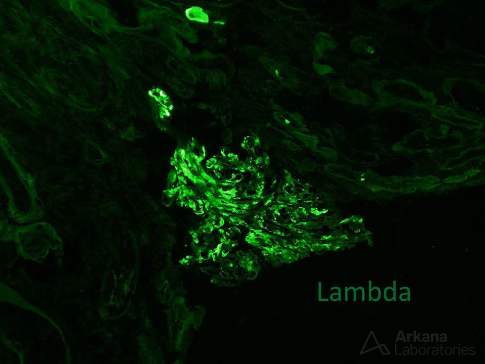 arkanalabs's tweet photo. DNAJB9 helps uncover dual pathology…
This case illustrates the utility of immunohistochemical staining for DNAJB9, a recently described biomarker for fibrillary glomerulopathy (see reference). The renal biopsy is taken from a 68-year-old man with a history of cirrhosis (cause unknown) who presents with mild microscopic hematuria, non-nephrotic range proteinuria, and chronic renal failure. Glomeruli show diffuse mild mesangial matrix expansion. Immunofluorescence shows granular mesangial IgA (2+) and smudgy mesangial and capillary wall IgG (2+) staining. Electron microscopy (not shown) shows both immune complex-type and fibrillary deposits involving glomerular capillary basement membranes and mesangium. Immunohistochemical staining for DNAJB9 shows mesangial staining.
Although IgA immunofluorescence staining may be observed in a subset of patients with fibrillary glomerulopathy, the presence of granular positivity and distinct immune complex-type deposits by EM in this case argue in favor of dual pathology: fibrillary glomerulopathy and IgA nephropathy. #TeachingPoints #RenalPath
Reference
Nasr SH, Vrana JA, Dasari S, Bridoux F, Fidler ME, Kaaki S, Quellard N, Rinsant A, Goujon JM, Sethi S, Fervenza FC, Cornell LD, Said SM, McPhail ED, Herrera Hernandez LP, Grande JP, Hogan MC, Lieske JC, Leung N, Kurtin PJ, Alexander MP. DNAJB9 Is a Specific Immunohistochemical Marker for Fibrillary Glomerulonephritis. Kidney Int Rep. 2017 Aug 8;3(1):56-64. PMID: 29340314