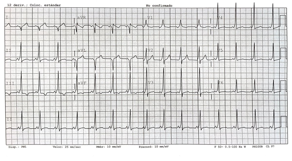 El ECG bonito de la guardia de ayer. 🫀
👦🏻de 22 años, sin antecedentes, por palpitaciones ocasionales. Sin síntomas cuando se le hizo el ECG.