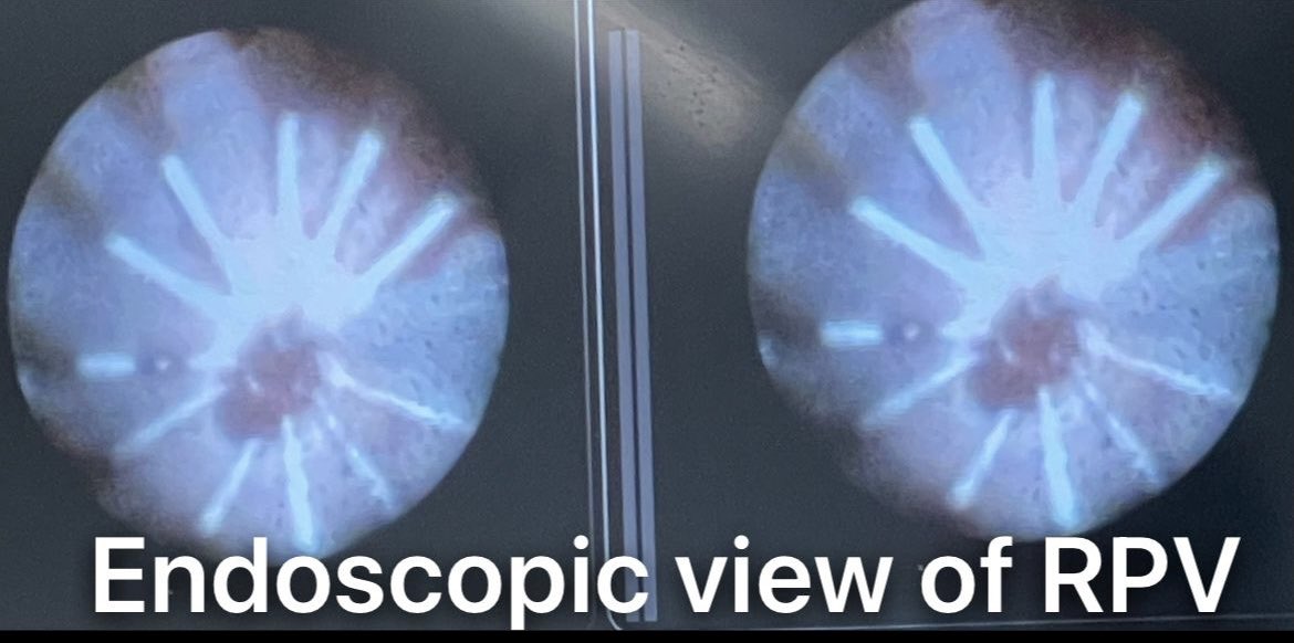 David Kenigsberg, MD (@dkenigsberg) on Twitter photo Post voltage map and endoscopic view obtained during ablation from a true single shot #PFA isolation of the SVC, RPV and LPV using a compliant <a href="/CardioFocusAF/">CardioFocus</a> balloon system with endoscopic visualization.
<a href="/hhuang123/">Henry D. Huang</a>, it was a pleasure working with you in your lab
#epeeps Post voltage map and endoscopic view obtained during ablation from a true single shot #PFA isolation of the SVC, RPV and LPV using a compliant <a href="/CardioFocusAF/">CardioFocus</a> balloon system with endoscopic visualization.
<a href="/hhuang123/">Henry D. Huang</a>, it was a pleasure working with you in your lab
#epeeps