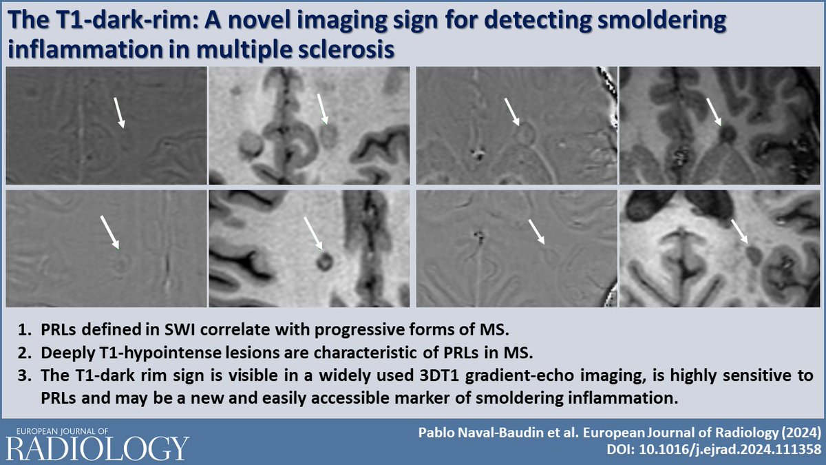 🎉 PUBLISHED TODAY !🔥Excited to share our work on the T1-dark rim as a promising marker for smoldering inflammation in #MultipleSclerosis. Discover how this novel imaging sign might impact diagnosis and treatment. 🧠 Read here: doi.org/10.1016/j.ejra…
#MRI <a href="/hbellvitge/">Hospital Universitari Bellvitge | HUB</a> <a href="/idi_cat/">Institut de Diagnòstic per la Imatge · IDI</a>