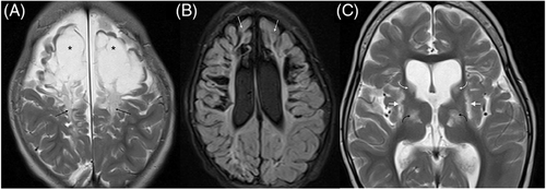 What happened on this MRI? Learn more about #cystic #neuroimaging patterns resulting from #hypoxic #ischemic #stroke in children @DAlkhulaifat @Dr_Shyam_Sunder @CHOPRadiology #neurology #neurosurgery #neurorad #pediatrics #pedsneuro #radres onlinelibrary.wiley.com/doi/full/10.11…