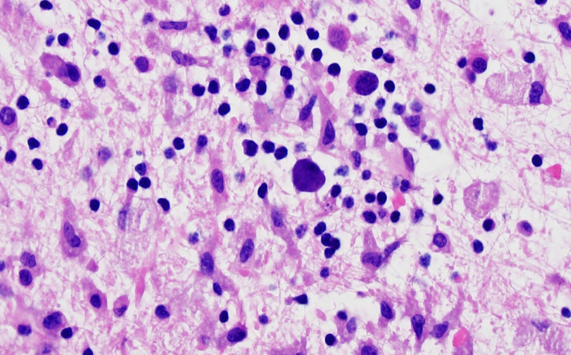 #Neuropath case 6 - immunocompromised adult with progressively altered mental status. MRI shows multifocal asymmetric white matter #brain lesions. H&amp;E from biopsy is shown. Diagnosis? What IHC would confirm your suspicion?