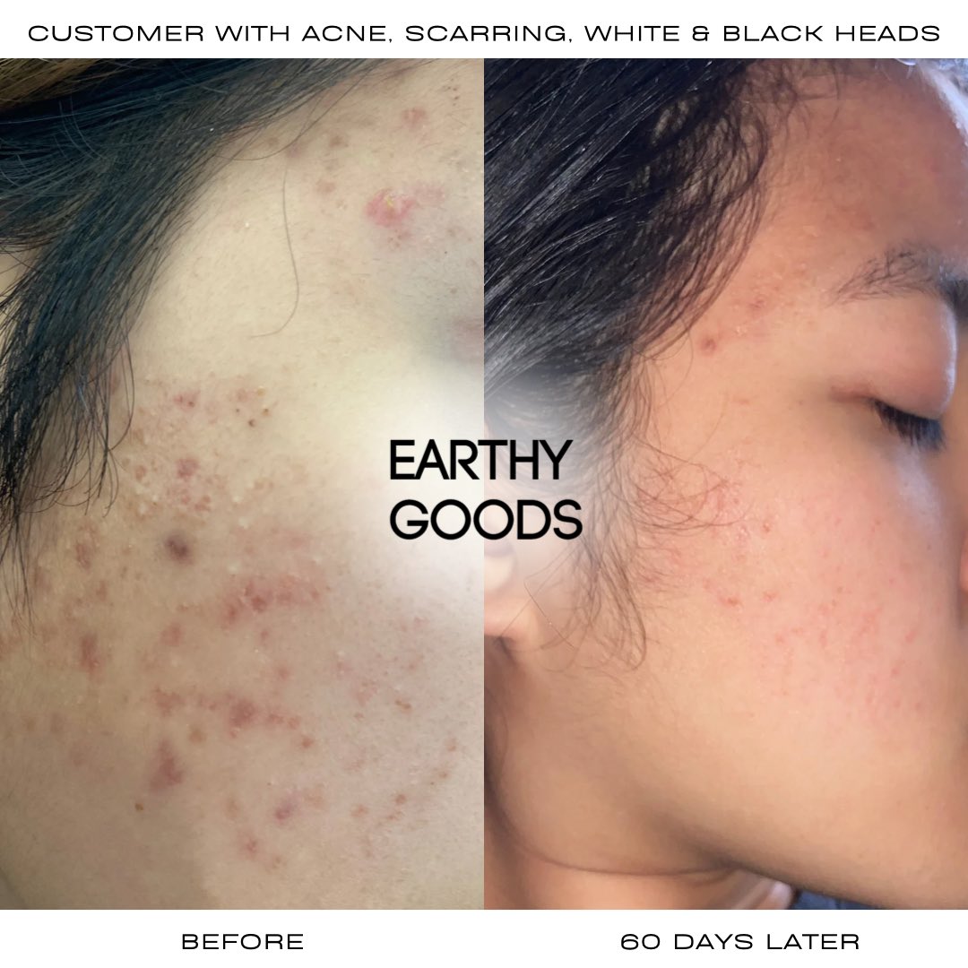 NaeemahsNE's tweet photo. This transformation, though 😮‍💨🤝

Healthier skin in just 60 days. This can be you! Products used were our Vitamin C Face Oil and Eucalyptus + Jasmine Cleanser 🌿

See more at https://t.co/ZPTjGPWxQu
Also sold on Amazon and Etsy! https://t.co/xpEVKUNo2S