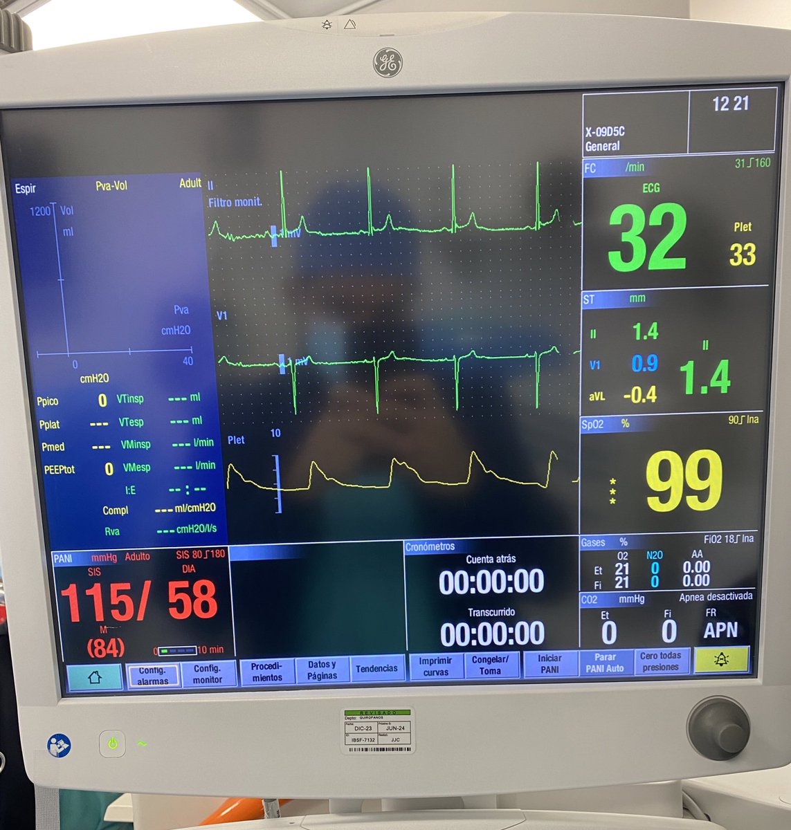 RicardoSernax's tweet photo. Dándole anestesia a un corredor de ultramaratones (100km o más) 
Bloqueo regional y sedación 😬 
Maravilloso como se adapta el sistema cardiovascular al ejercicio🫀🏃‍♂️ https://t.co/k7QSmqEeRf