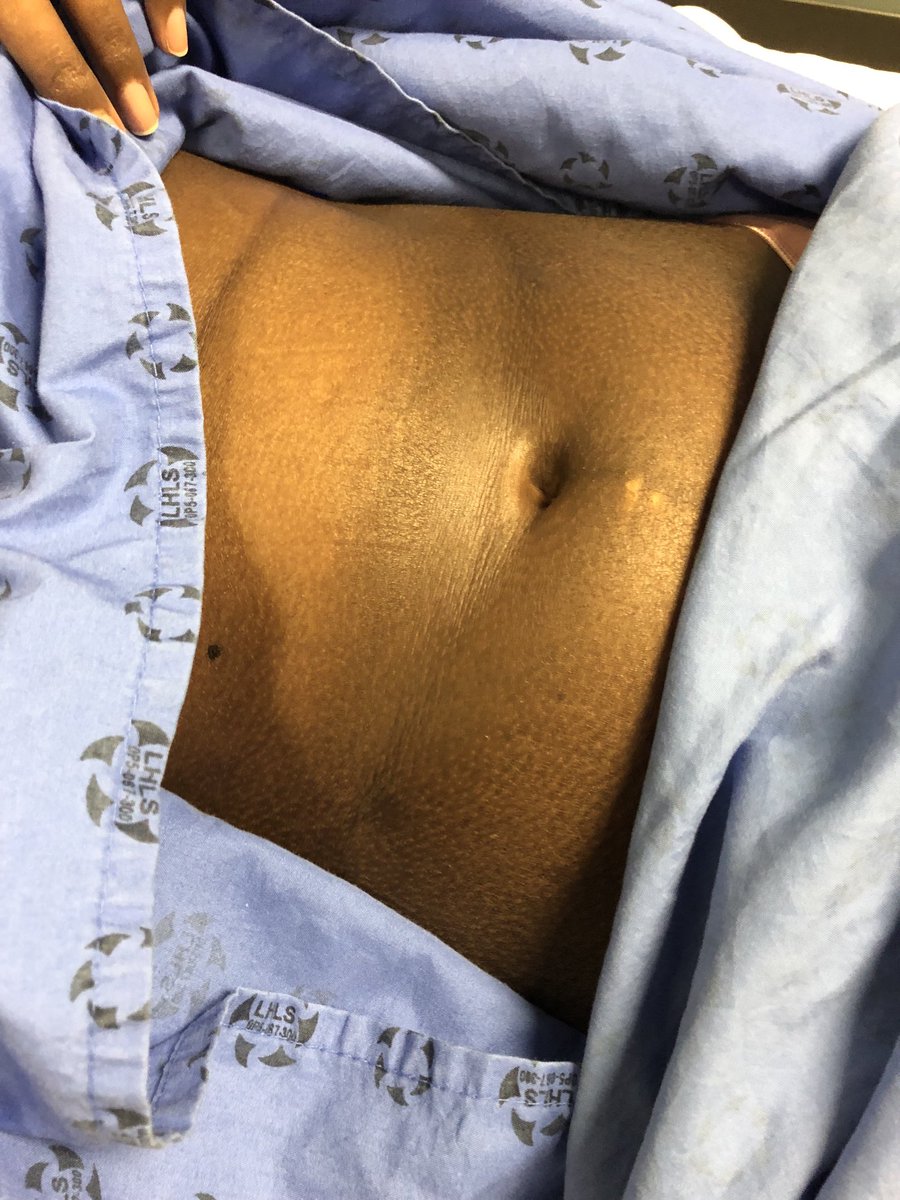 Janetbirdope's tweet image. #ClinicalPearl
#diffuse #cutaneous #systemic  #sclerosis 
Note 
-increased pigmentation 
-salt and pepper pigment changes 
-skin involvement proximal to elbows 

#scleroderma #dcSSc