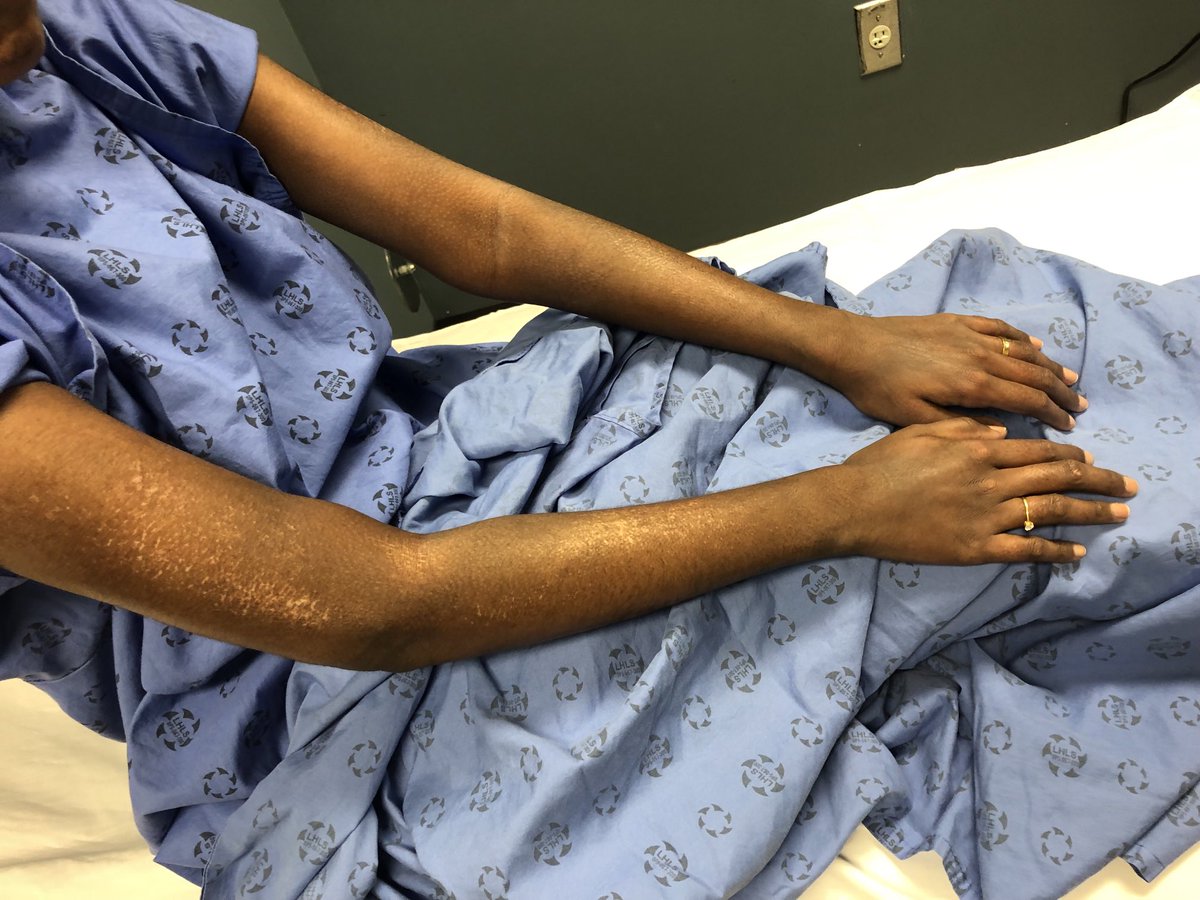 Janetbirdope's tweet image. #ClinicalPearl
#diffuse #cutaneous #systemic  #sclerosis 
Note 
-increased pigmentation 
-salt and pepper pigment changes 
-skin involvement proximal to elbows 

#scleroderma #dcSSc
