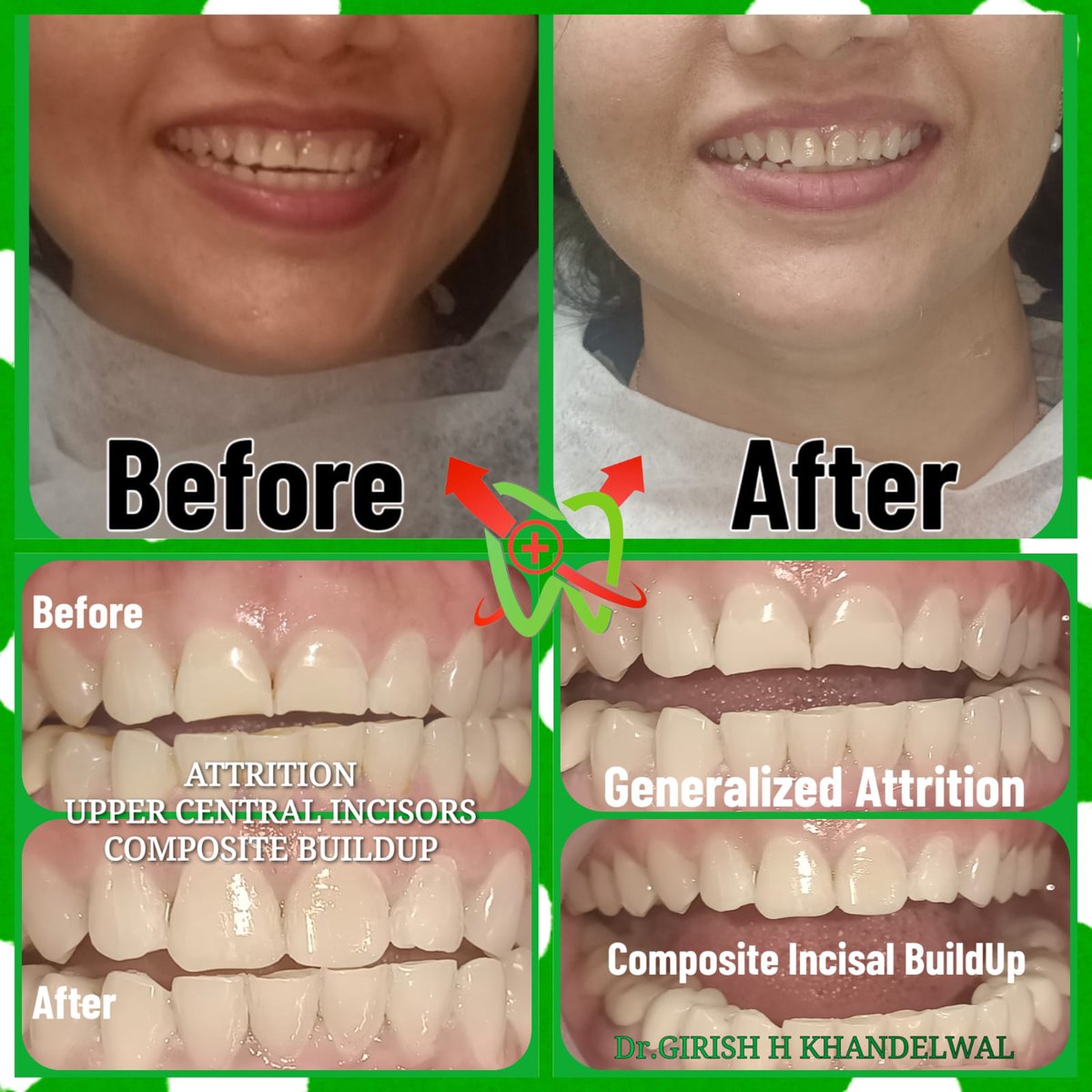 SMTDCC2010's tweet photo. " A simple Treatment with ExtraOrdinary Results

45MINS SMILE DESIGNING

Dr.GIRISH H KHANDELWAL
StMother Teresa DentalClinic  

9664988588 • 9664988589

#smiledesign #smiledesigning #smiledesigner #SmileDesignDentistry #attrition #dentalattrition #toothattrition #teethattrition https://t.co/74Tfc77zBI