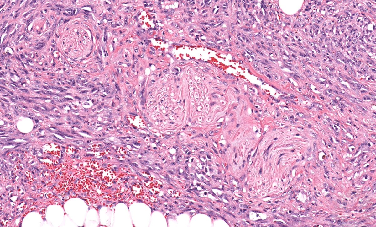 JMGardnerMD's tweet photo. 75 yo face. Your diagnosis? 
WSI digital slide: https://t.co/DelDYSwuyW
Answer &amp; video: https://t.co/pGAALBsfFD 
#pathology #pathologists #pathTwitter #dermpath #dermatology #dermatologia #dermtwitter #BSTpath https://t.co/wMaYEwk8lp