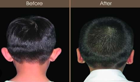 visionsichuan's tweet photo. 最近韩国流行后脑勺整形,整形前要往头里灌水泥……OMG
Recently, a plastic surgery on the back of the head, which is popular in #SouthKorea, injecting bone cement into the head before surgery...OMG
#plasticsurgery #roundhead #JesusChrist #둥근머리성형수술 https://t.co/doxDDYLZB8