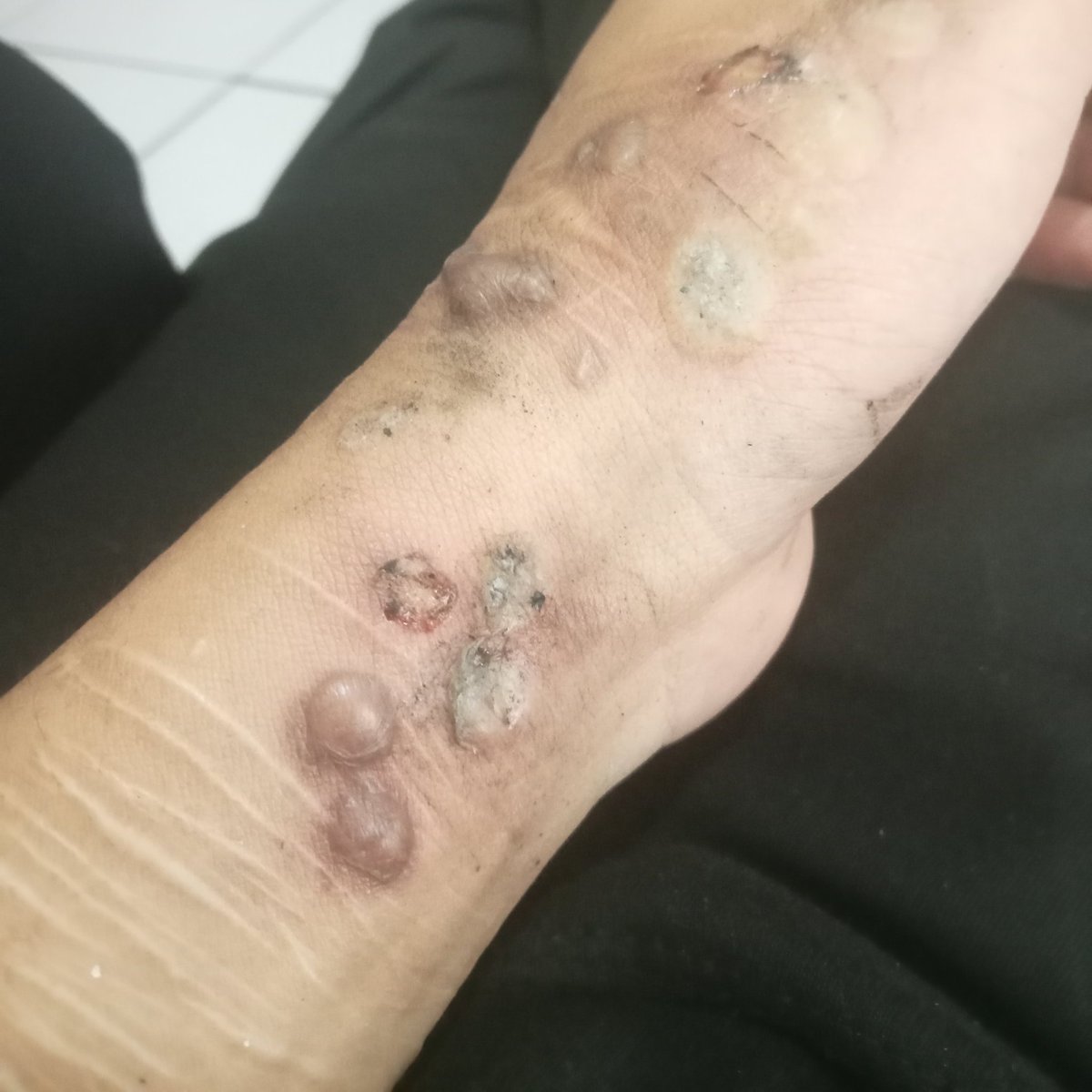 us23l63ss's tweet photo. cig burn | tw https://t.co/Al0JHbiuLe