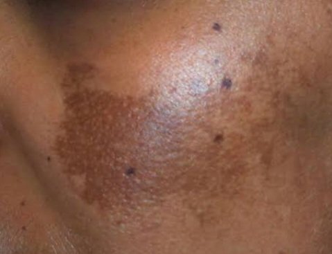 NicmarkDerma's tweet photo. Some of the causes of Melasma:
1- sunlight exposure 
2- pregnancy 
3- certain medication 
4- thyroid disease
5- cosmetics, etc https://t.co/NqAYrDpjro