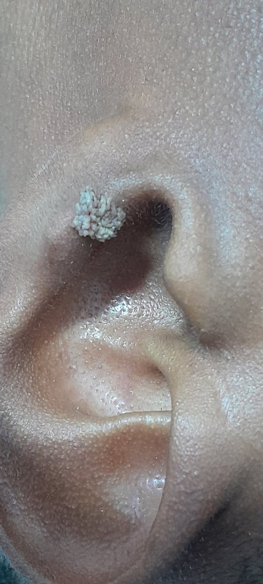 NicmarkDerma's tweet photo. Warts removal using Electro cautery. https://t.co/pXD3ONpM19