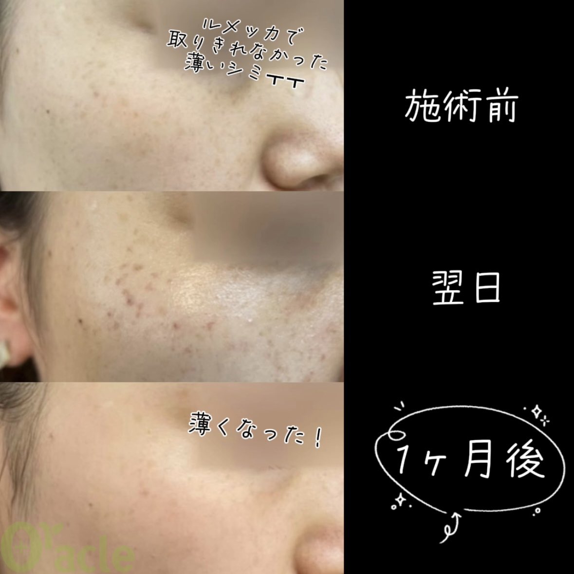 オラクル美容皮膚科【公式】 on X