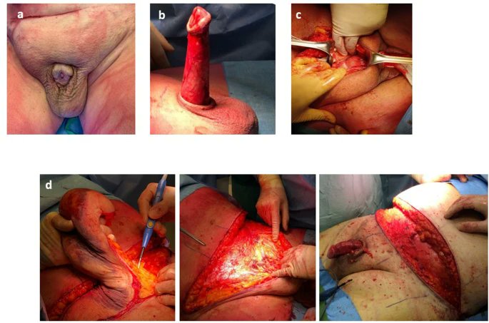 No difference between split-thickness and full-thickness skin grafts for surgical repair in adult acquired #buriedpenis regarding surgical and functional outcomes👉rdcu.be/dx2Nl @docctoore @N_Plamadeala @drMarcoFalcone1 @drMirkoPreto @FedericaPeretti @paolo_gontero