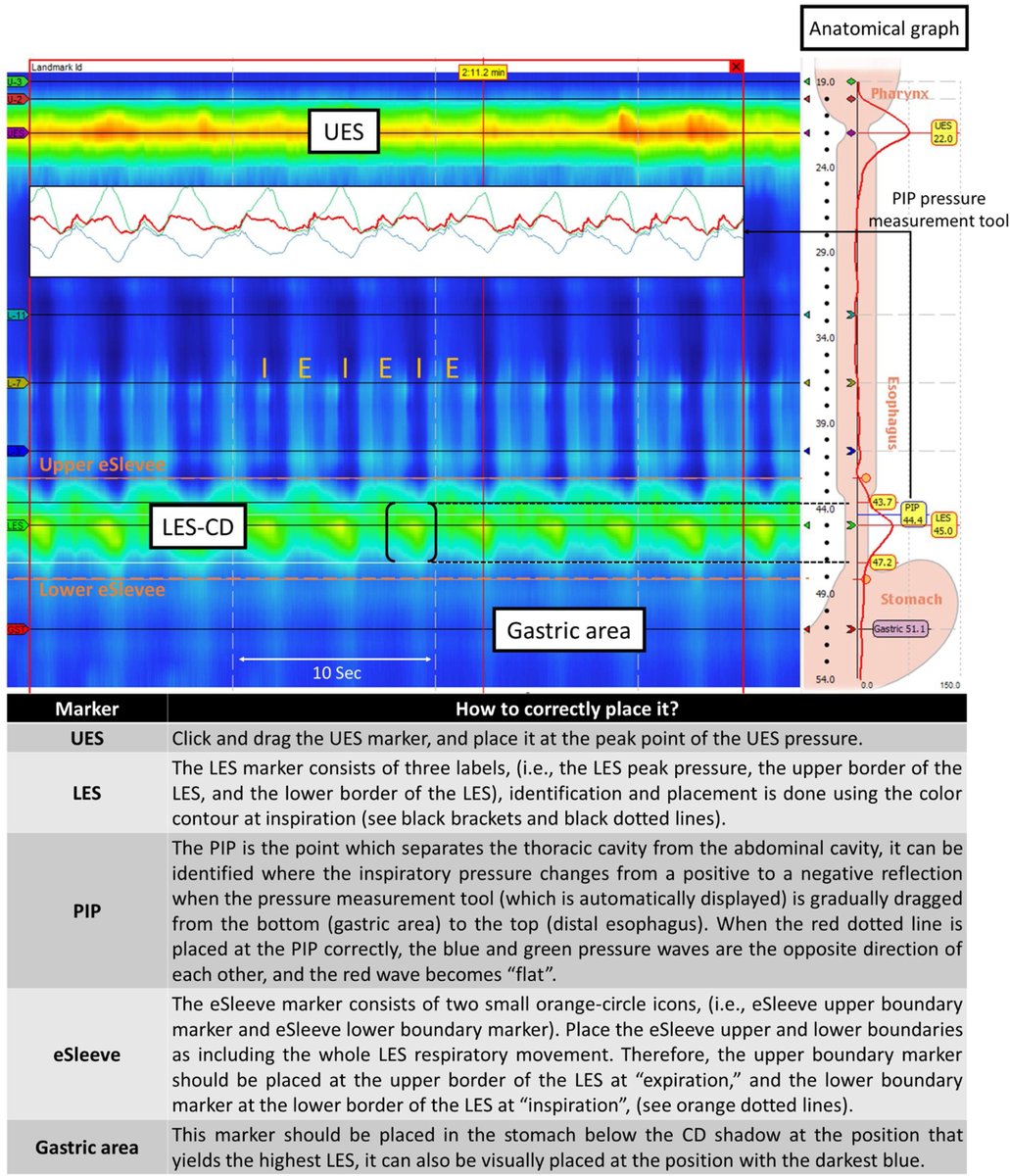 Brief guidelines for beginners on how to perform and analyze esophageal high-resolution manometry. elsevier.es/es-revista-gas…