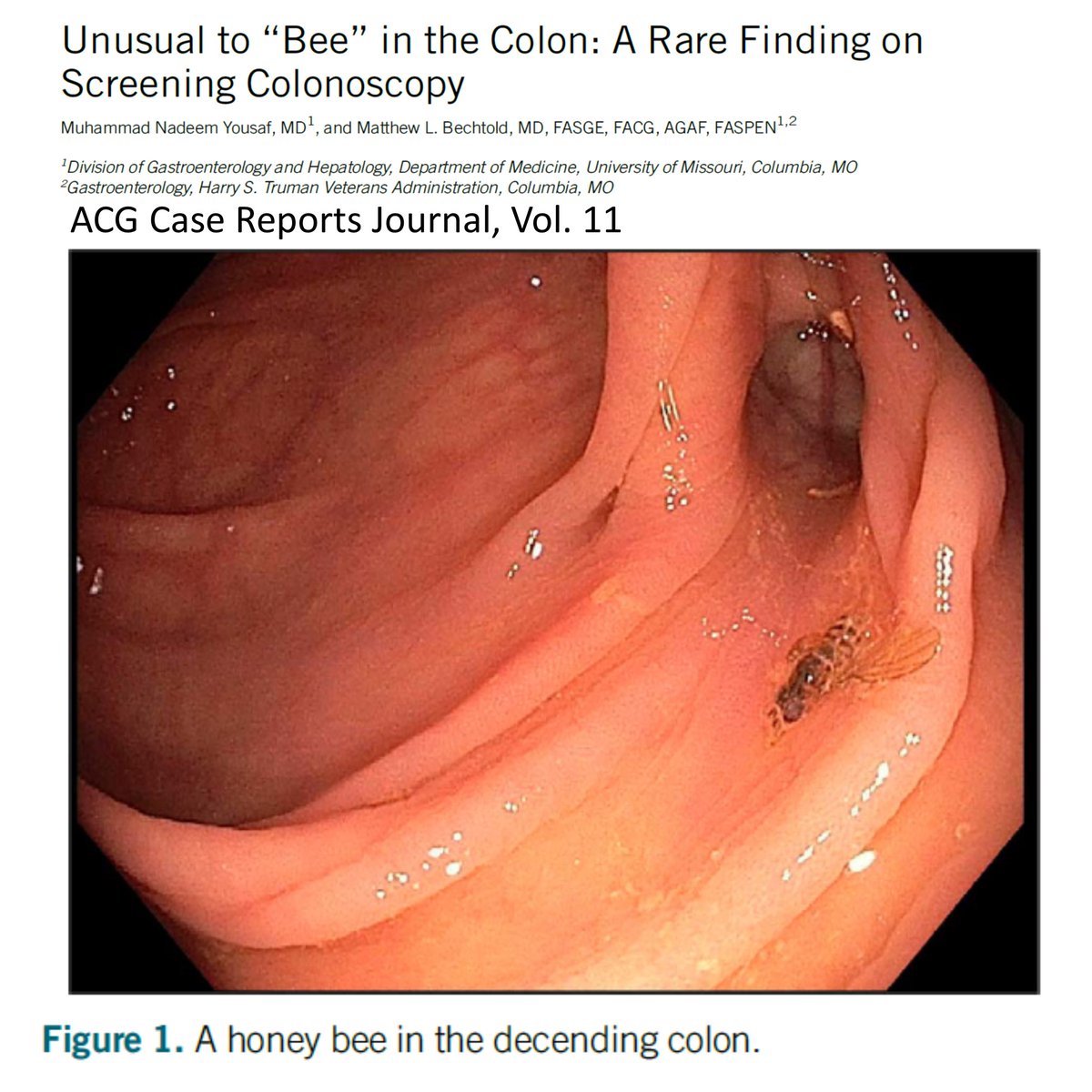 You just never know what MU gastroenterology fellow Nadeem Yousaf will find during colonoscopy.