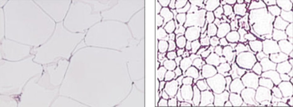 How we store fat matters more than how much fat we store. This idea emphasizes the importance of the size of each individual fat cell, rather than the total mass of the fat. This image compares fat cell size of South Asian men (left) and Caucasian men (right). Note the incredible
