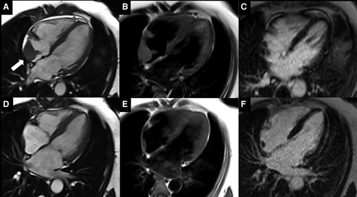 MSHCVImaging's tweet image. Now in @ESC_Journals, our group presents an incredible case of significant plasmacytoma regression by CMR! Check it out ⬇️⬇️⬇️
tinyurl.com/4uybyphe
@SWBienMD
@doctorginaL
@ferresc92
@MichaelHadleyMD
@SinaiCards
@MountSinaiHeart