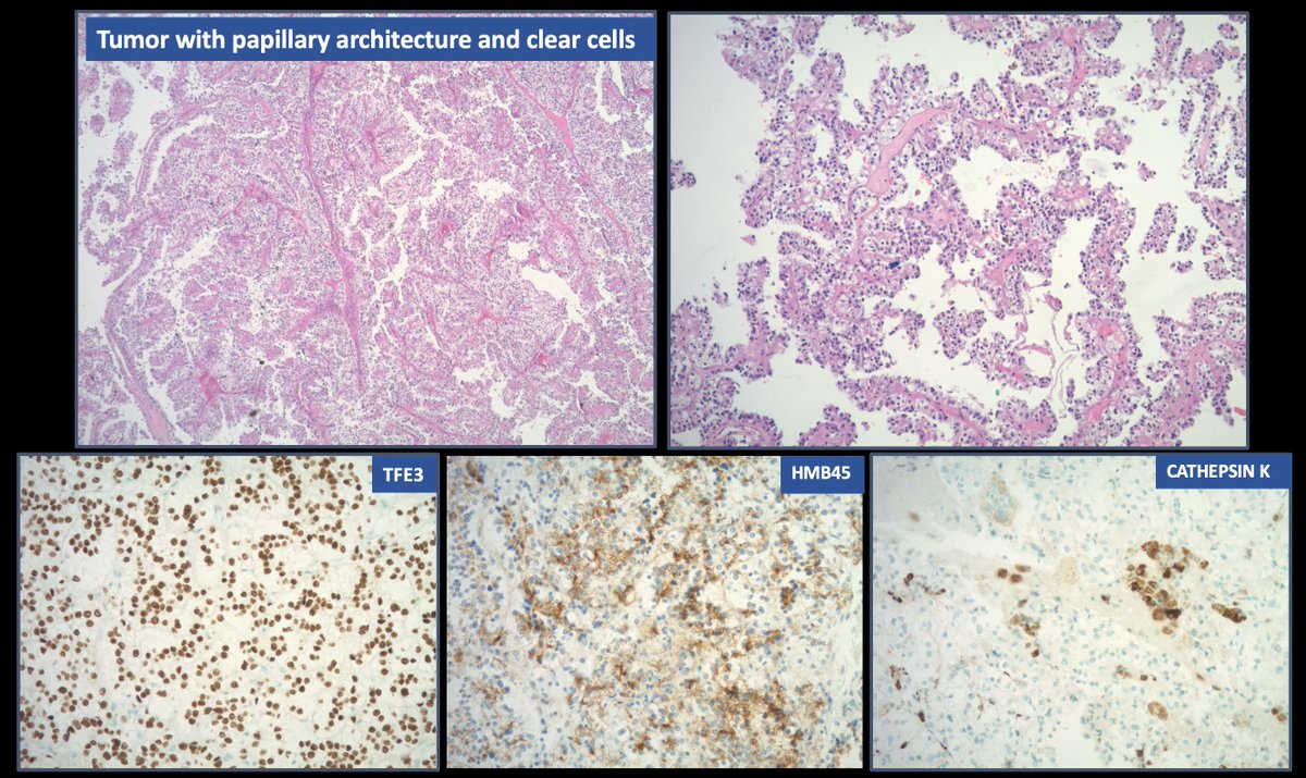 RSekhri_MD's tweet photo. Kidney tumor - characteristic morphology although not too many psammoma bodies
Xp11.2 translocation - positive
Final diagnosis - TFE3 rearranged RCC
@kkuanMD @hania1234 @ridin_bk_MD https://t.co/b8RHKFWog7