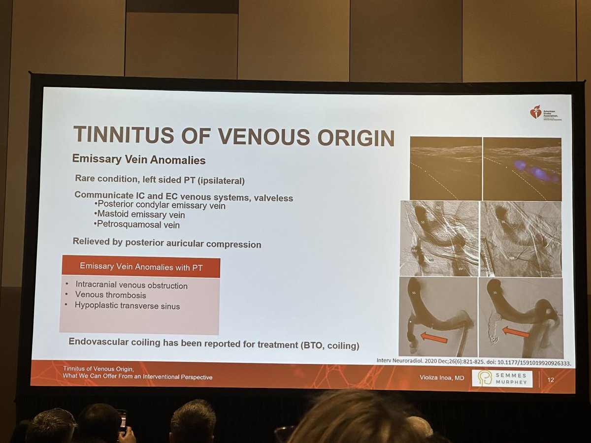 Violiza Inoa continues the Vein Voyage by highlighting pathophysiologies of cerebral venous anomalies leading to disabling pulsatile tinnitus & potential endovascular tx #ISC24 #stroke @AHAScience