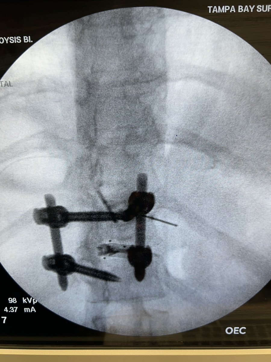 Intercostal cryoneurolysi is always almost performed using the ultrasound. In this case, the 47-year-old female, who had T11 and and T 12 laminectomy with fusion present with axial back pain which was nonresponsive to medial branch blocks and thoracic epidural injection. (Done