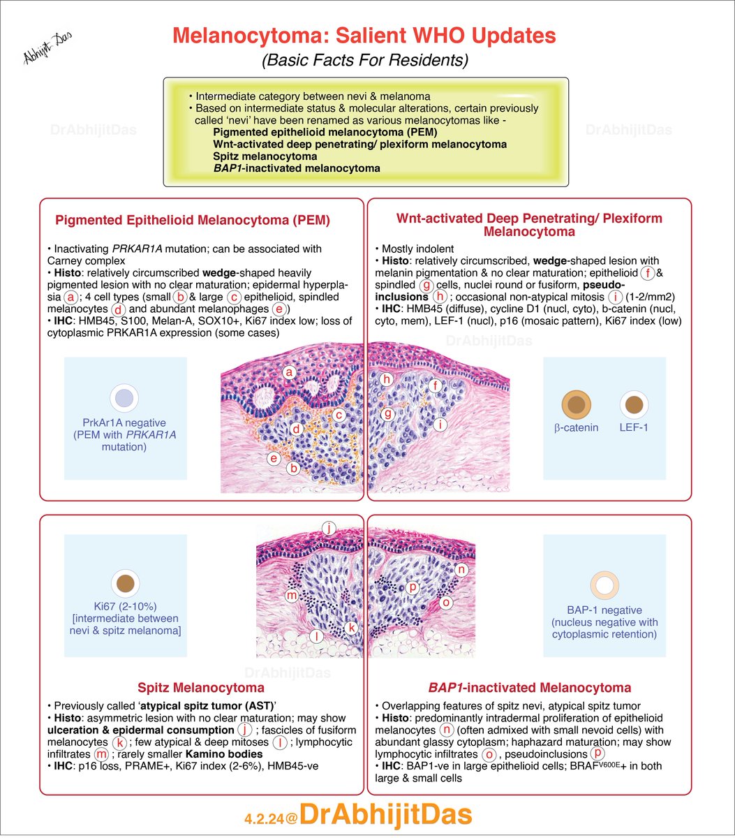 Melanocytoma: WHO updates
Basic facts for residents...

#MakeSuriPathEasy
#Melanocytoma