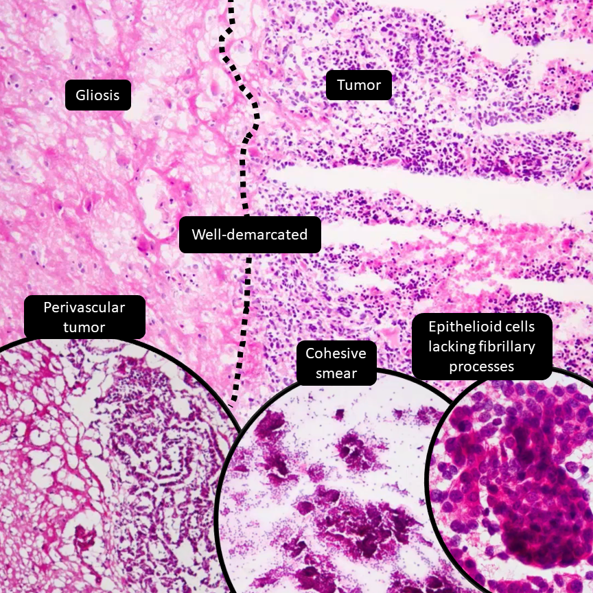 DrCycloPath's tweet photo. Brain tumor, primary or metastasis?
#Neuropath #PathResidents #PathTwitter https://t.co/XieZDiO7Ro