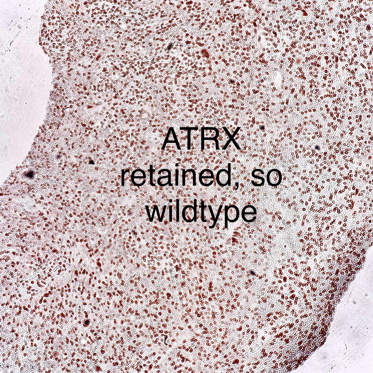 Path4People's tweet photo. Parietal Lobe Mass:

Glioblastoma, IDH-Wildtype, CNS WHO Grade 4

Methylation of MGMT promoter gene: Not detected

#pathagonia #pathx #neuropath #pathology #neurosurg #hemeonc #medx #neurology #medstudent #medicine #cancer #glioblastoma #surgpath https://t.co/pe1S7JNvNm