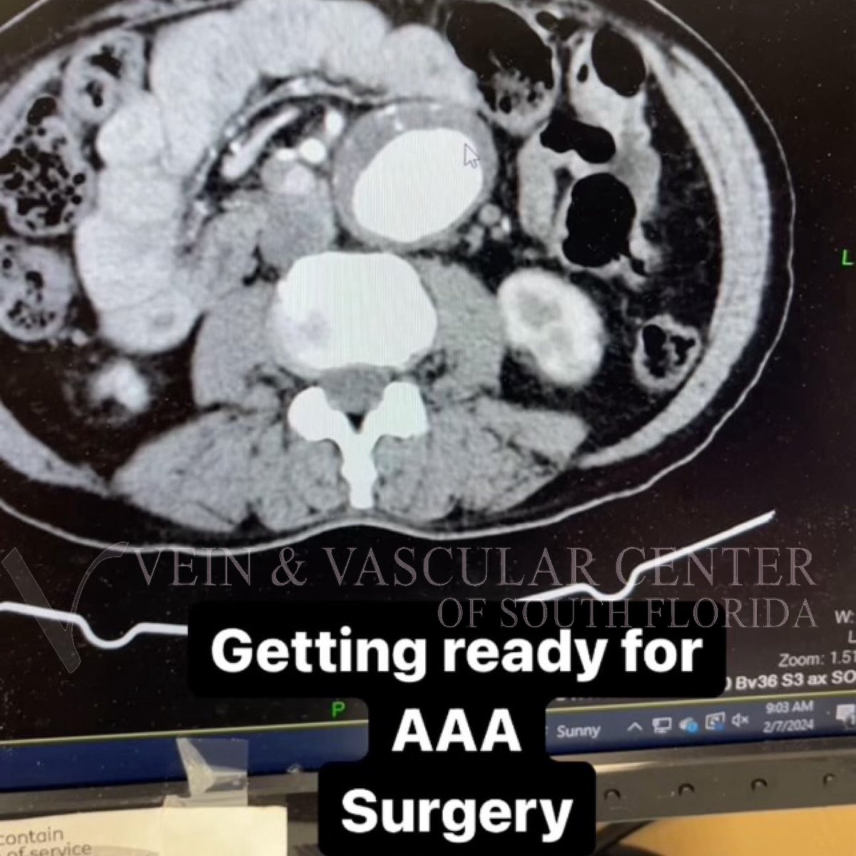 GotVeins's tweet photo. We Specialize in Life Saving Surgery for Aortic Aneurysms.  Come See Us for Expert Care or  a Second Opinion. Call (954) 964-6684 to Schedule Your Appointment. We Accept Most Insurance. #vascularsurgeon https://t.co/ZkZD177BIp