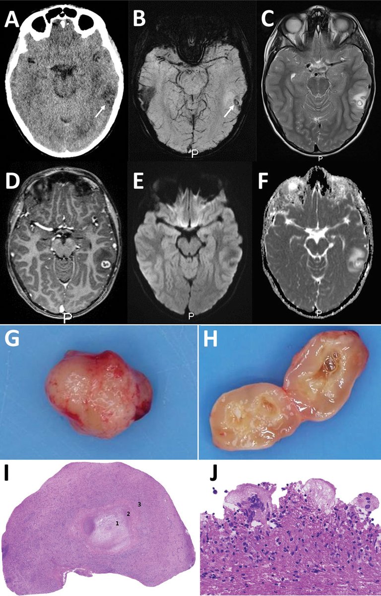 A neurocysticercosis-like lesion in an 11-year-old boy in the Netherlands was determined to be caused by the #zoonotic Taenia martis #tapeworm. Read more in this new early release EID journal article, online now. bit.ly/486OWan