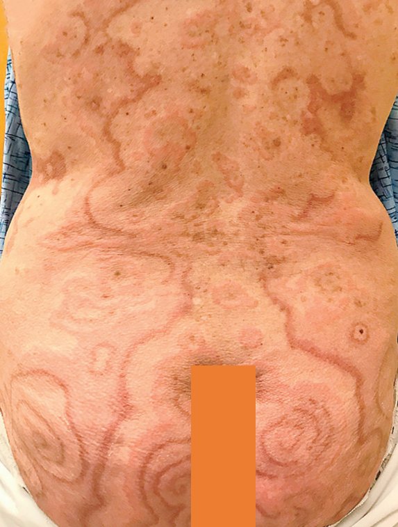 What is the Skin Rash?
Associations?