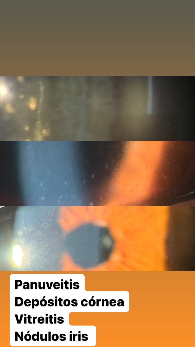 Panuveitis en hombre de 75 años. Descartar enfermedades sistémicas