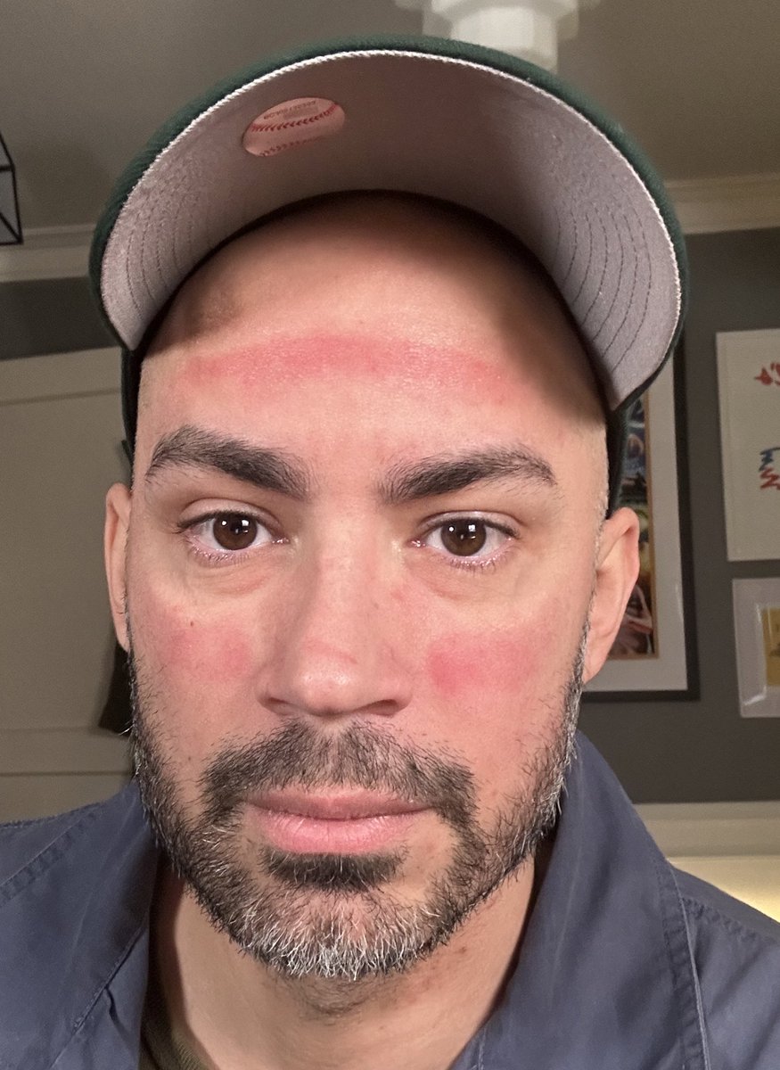 NemPerez's tweet photo. VR FACE. It’s a real thing. Just spent an hour talking to my developer in the spatial world using Apple Vision Pro and this is what my face looks like afterwards. Is this the future? https://t.co/325ltsGT5k
