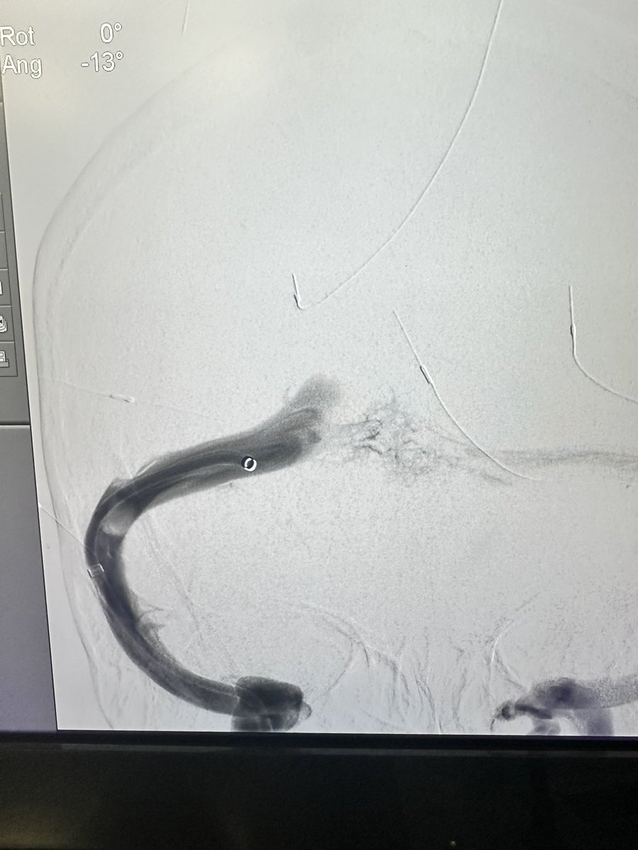 RitamGhoshMD's tweet image. Thrilled to perform the first ever venous sinus stent at Jefferson Washington Township for IIH. Looking forward to providing care to this patient population at @JeffHealthNJ. Wouldn’t be possible without the unparalleled training I received from @TJUHNeurosurg!!