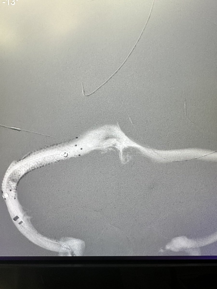 Ritam Ghosh (@ritamghoshmd) on Twitter photo Thrilled to perform the first ever venous sinus stent at Jefferson Washington Township for IIH. Looking forward to providing care to this patient population at <a href="/JeffHealthNJ/">Jefferson Health - New Jersey</a>. Wouldn’t be possible without the unparalleled training I received from <a href="/TJUHNeurosurg/">Jefferson Neurosurgery</a>!! Thrilled to perform the first ever venous sinus stent at Jefferson Washington Township for IIH. Looking forward to providing care to this patient population at <a href="/JeffHealthNJ/">Jefferson Health - New Jersey</a>. Wouldn’t be possible without the unparalleled training I received from <a href="/TJUHNeurosurg/">Jefferson Neurosurgery</a>!!