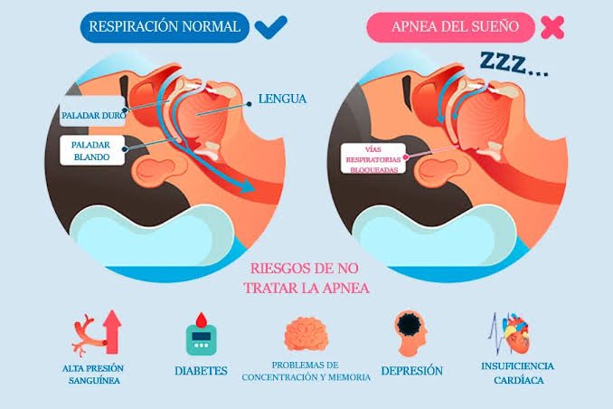 DavidForeroMD's tweet photo. A quien pueda interesar:
Si su pareja #ronca mucho cuando duerme, revise si está haciendo “pausas respiratorias”.
Si las llega a evidenciar, consulte lo más pronto a su médico, esto puede ser un síntoma de un trastorno llamado apnea obstructiva del sueño (AOS).
🧵 https://t.co/K34jG4jaFC