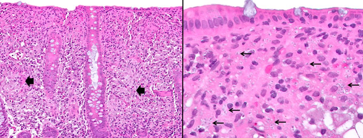 katcollmd's tweet photo. @FridaRosenblum presumed Crohn disease by clinical presentation and endoscopy, no prior biopsies or immunosuppression #pathcritters #surprisemycosis  #pathtwitter 

☝🏼 critical to rule out infection, including fungal, in pts with suspected IBD before starting immunosuppressive therapy https://t.co/oKWbkA86DR